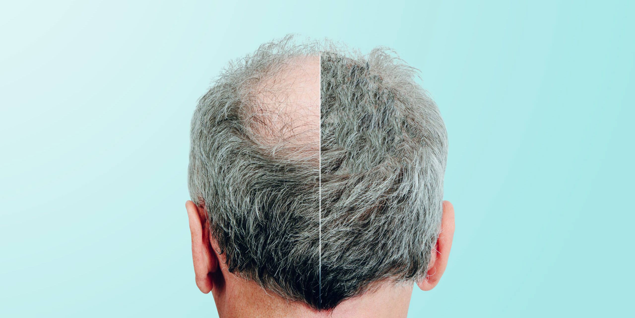 PRP Treatment for hair loss - La Maison Medicale - Kensington International  Clinic